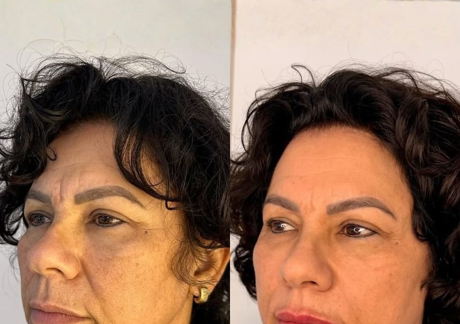 Antes e depois de rejuvenescimento facial