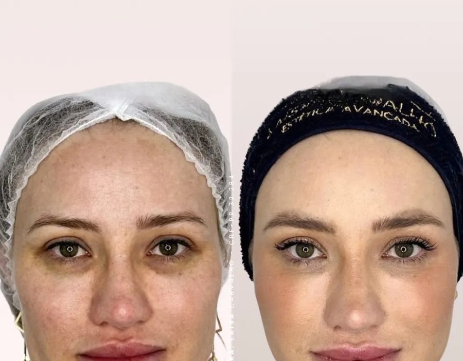 Antes e depois do protocolo Firm & Lifting