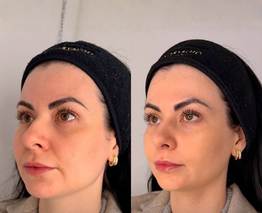 Antes e depois de tratamento de sorriso triste e bigode chinês