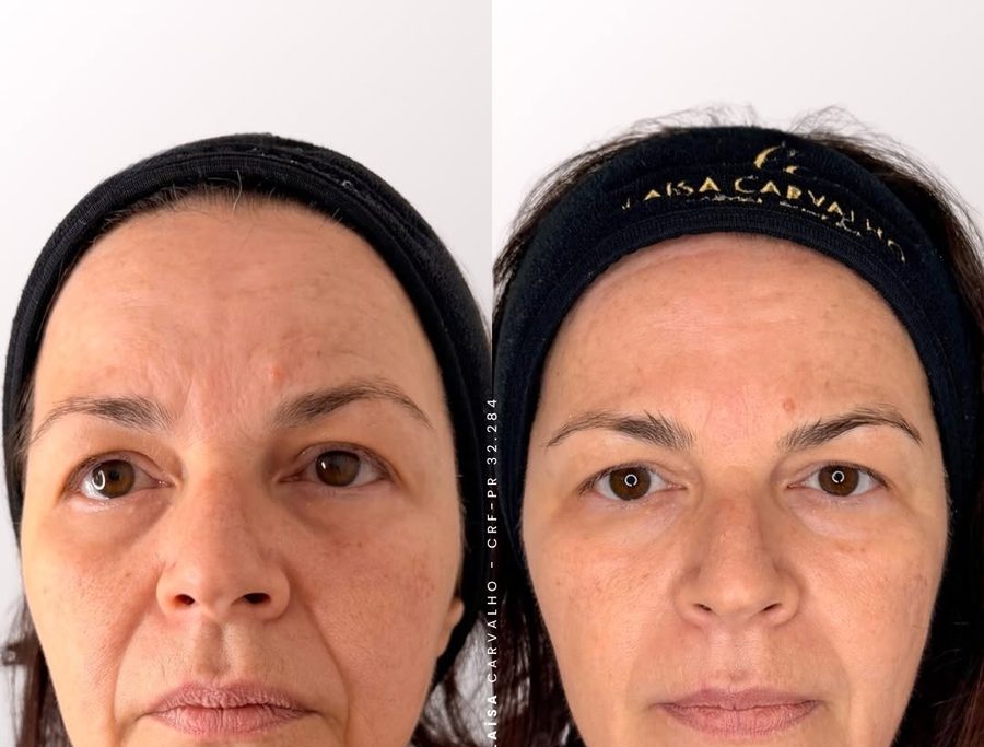 Antes e depois de ultrassom microfocado facial